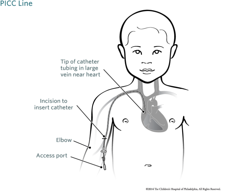 Intravenous Antibiotics for Lyme: Pros, Cons, and the Lived Experience